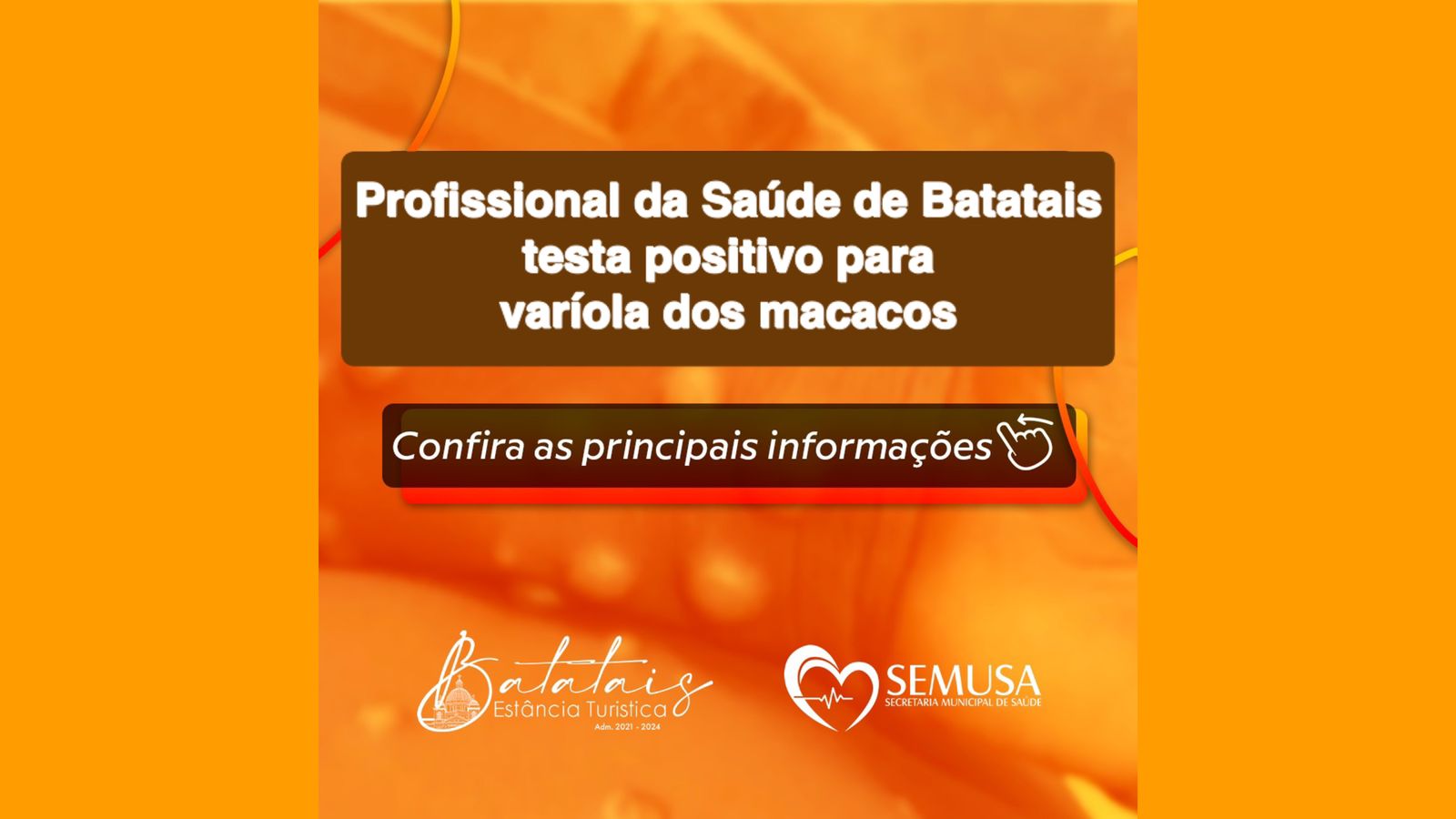 Profissional da Saúde de Batatais testa positivo para varíola dos macacos